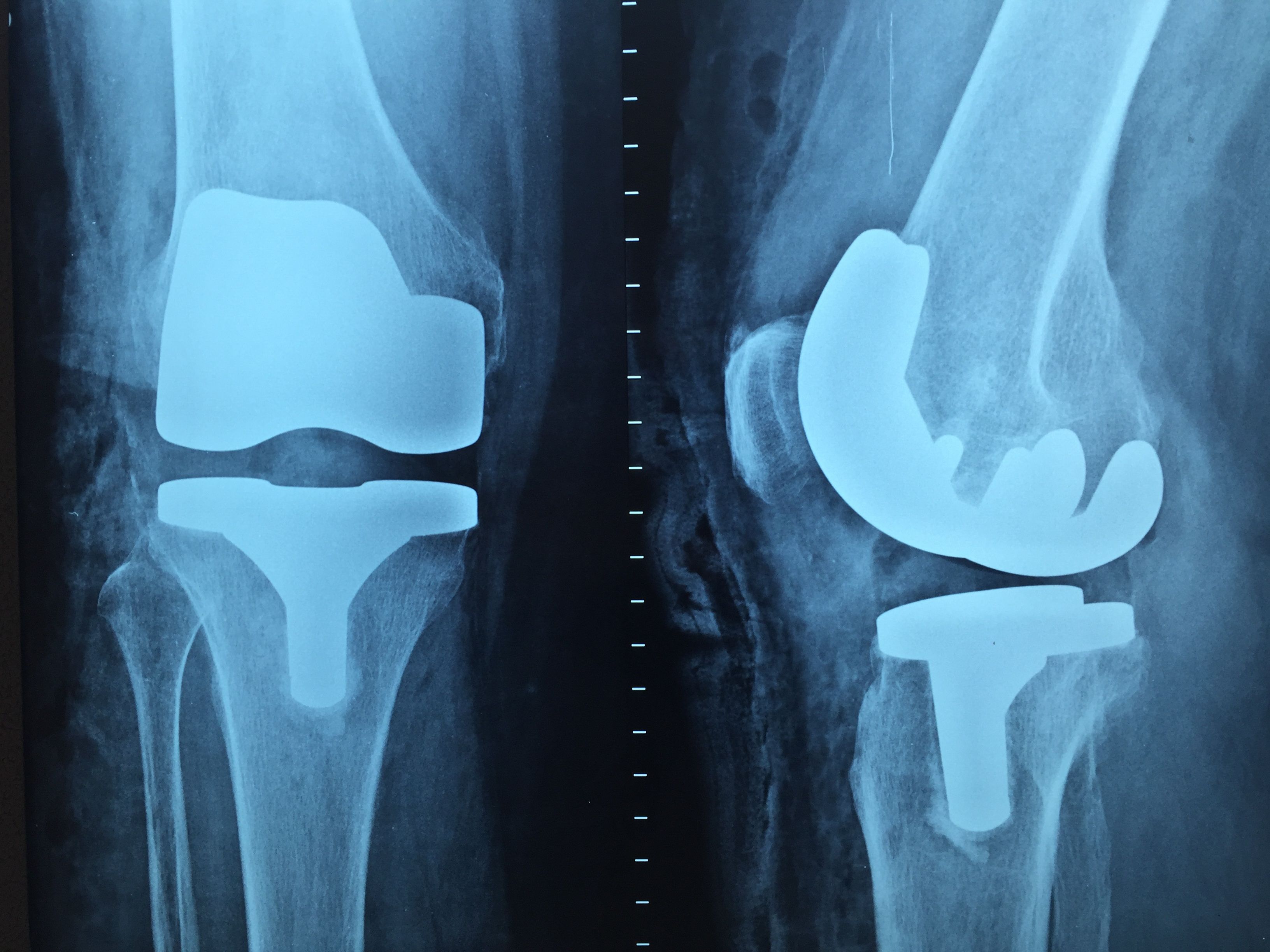 Osteoarthritis treatment